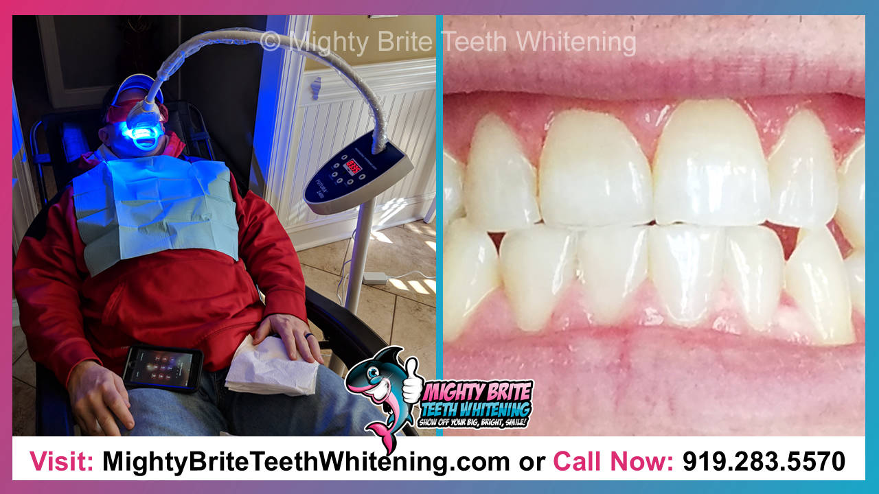 Blue Light Teeth Whitening Clayton Raleigh NC